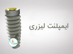 ایمپلنت لیزری در یک نگاه